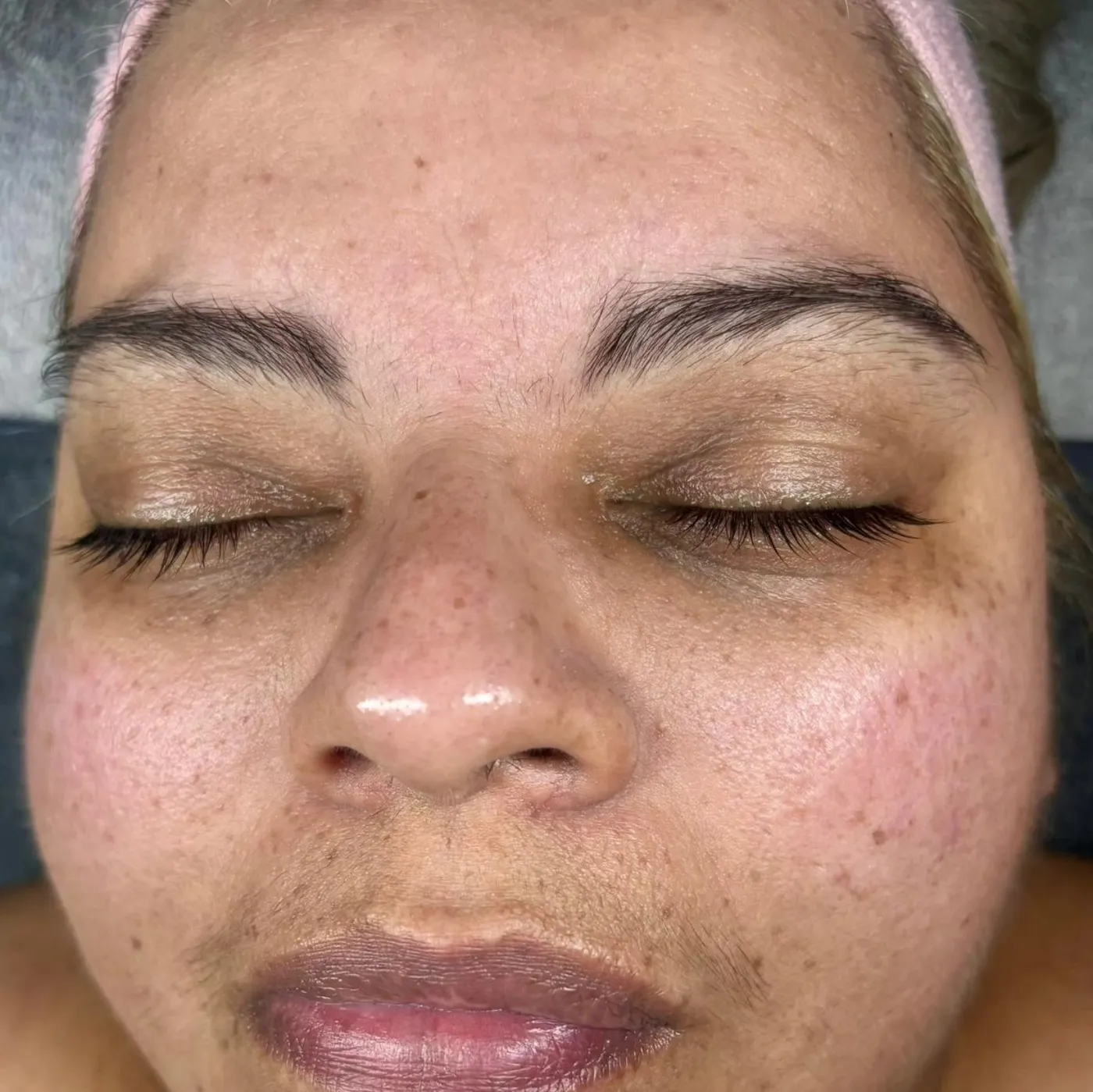 Skin after a dermaplaning facial