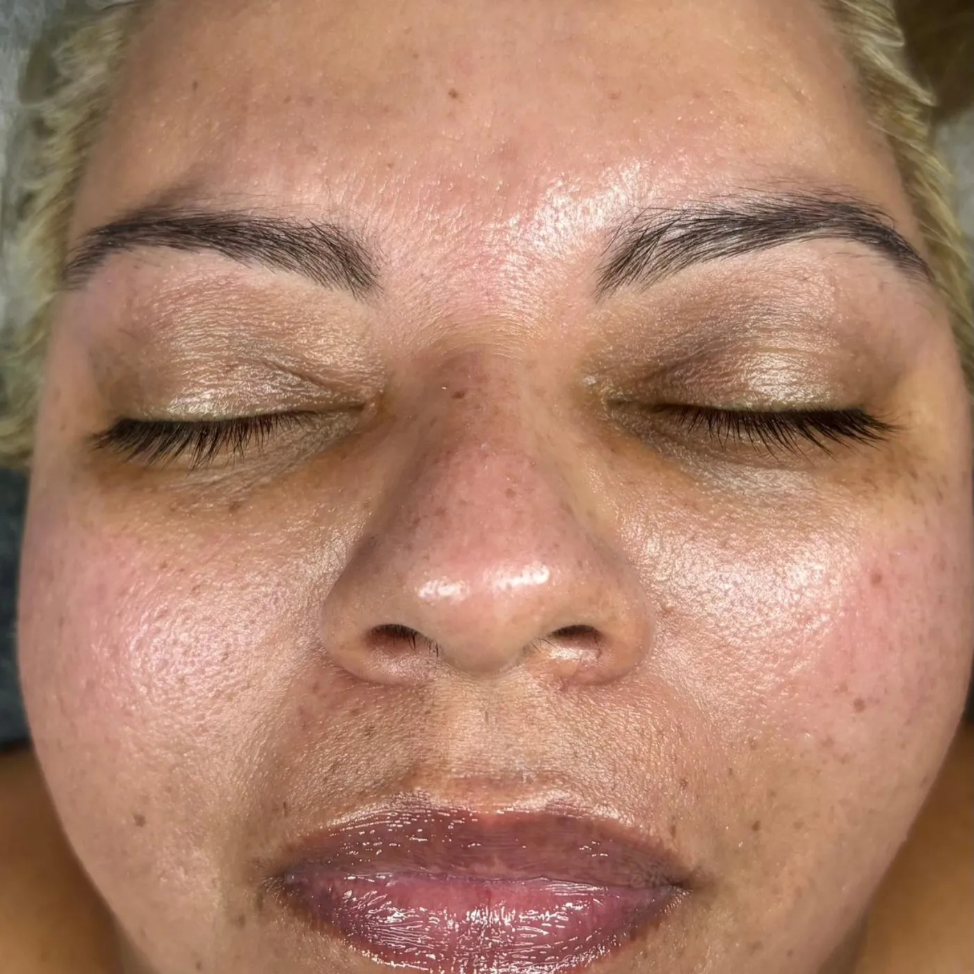 Dermaplaning, before, before and after