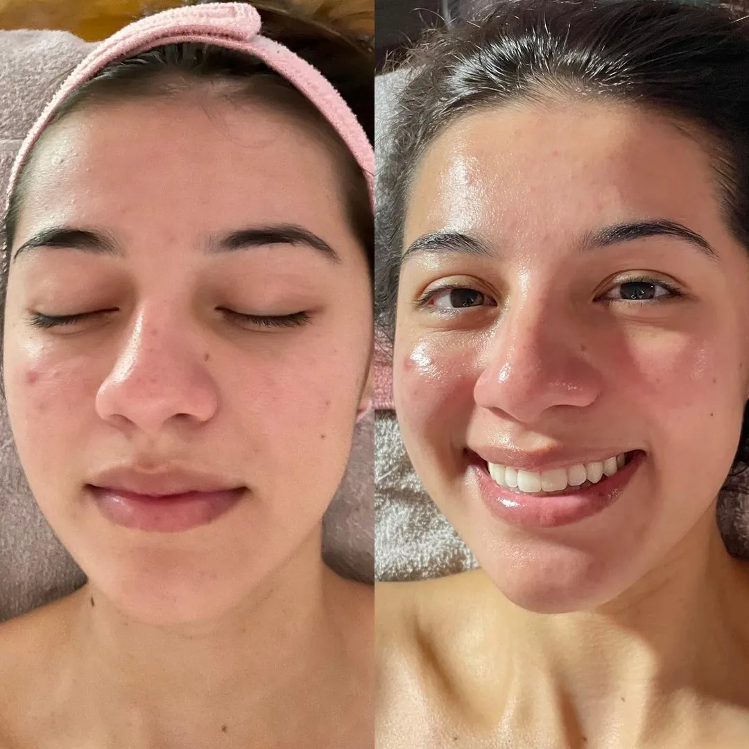 Signature facial, before and after