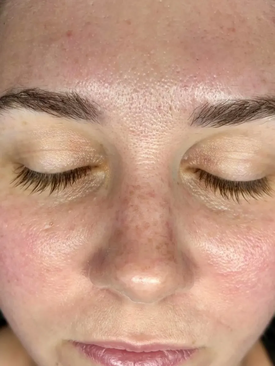 A client's skin immediately after hydrodermabrasion