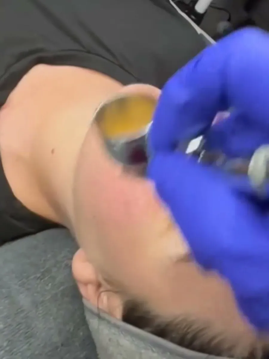 Oxygen infusion being applied after the diamond tip