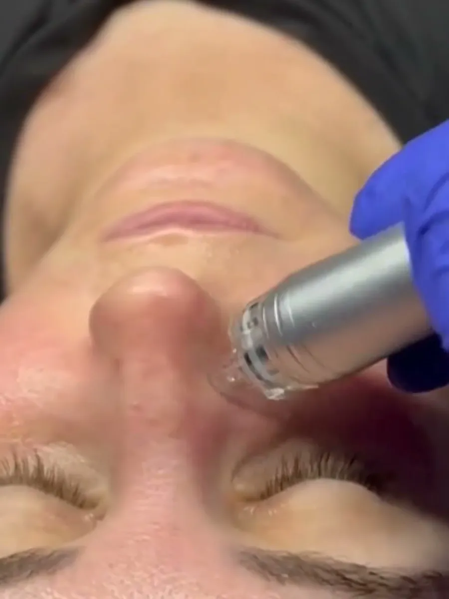 The hydrodermabrasion tip working across a client's nose