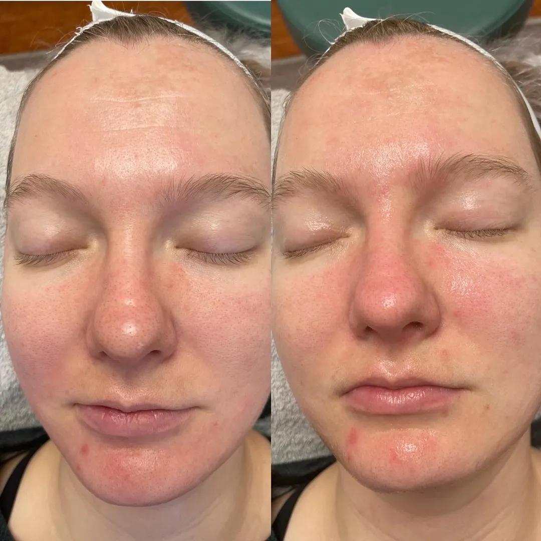 Chemical peel series, before and after