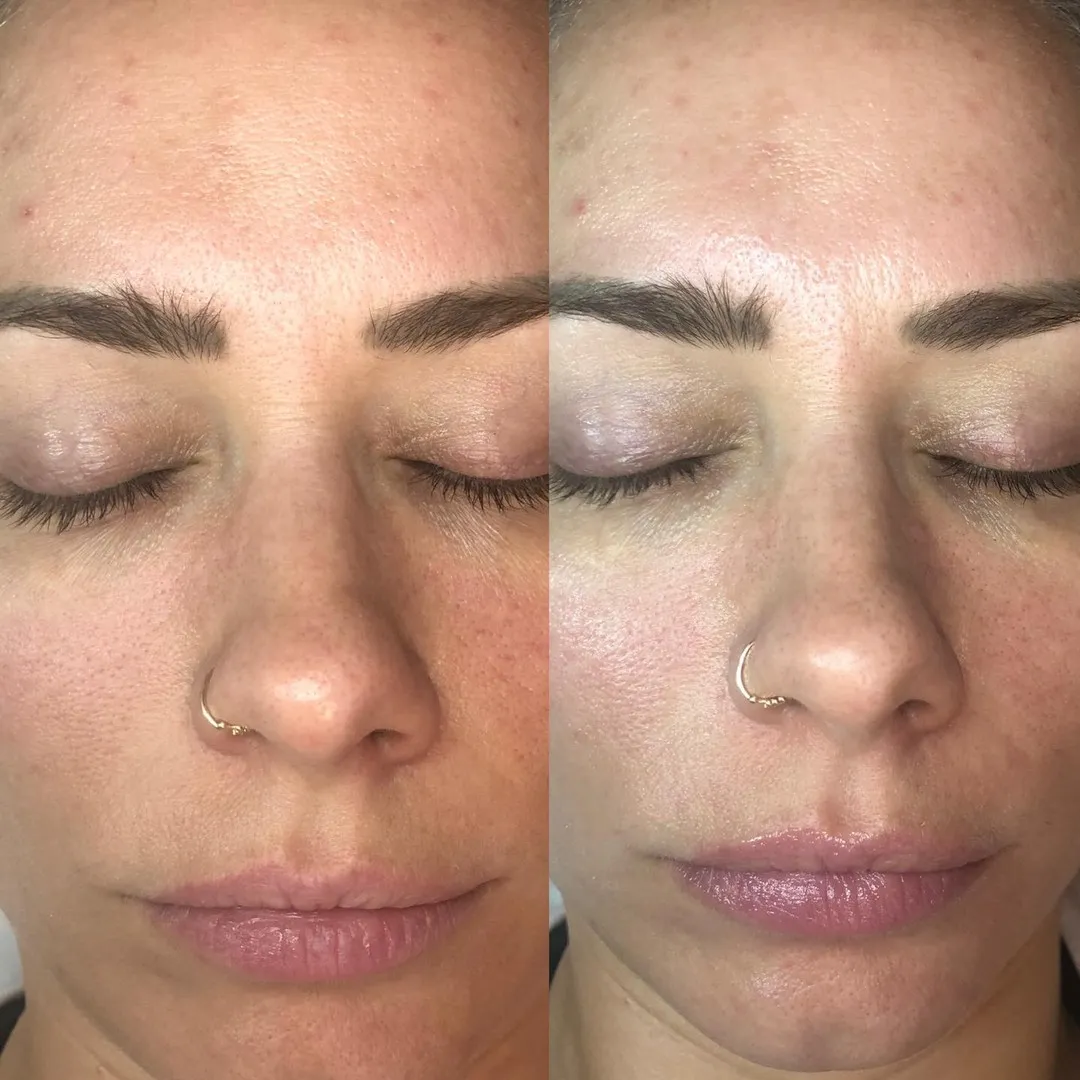 Chemical peel series, before and after