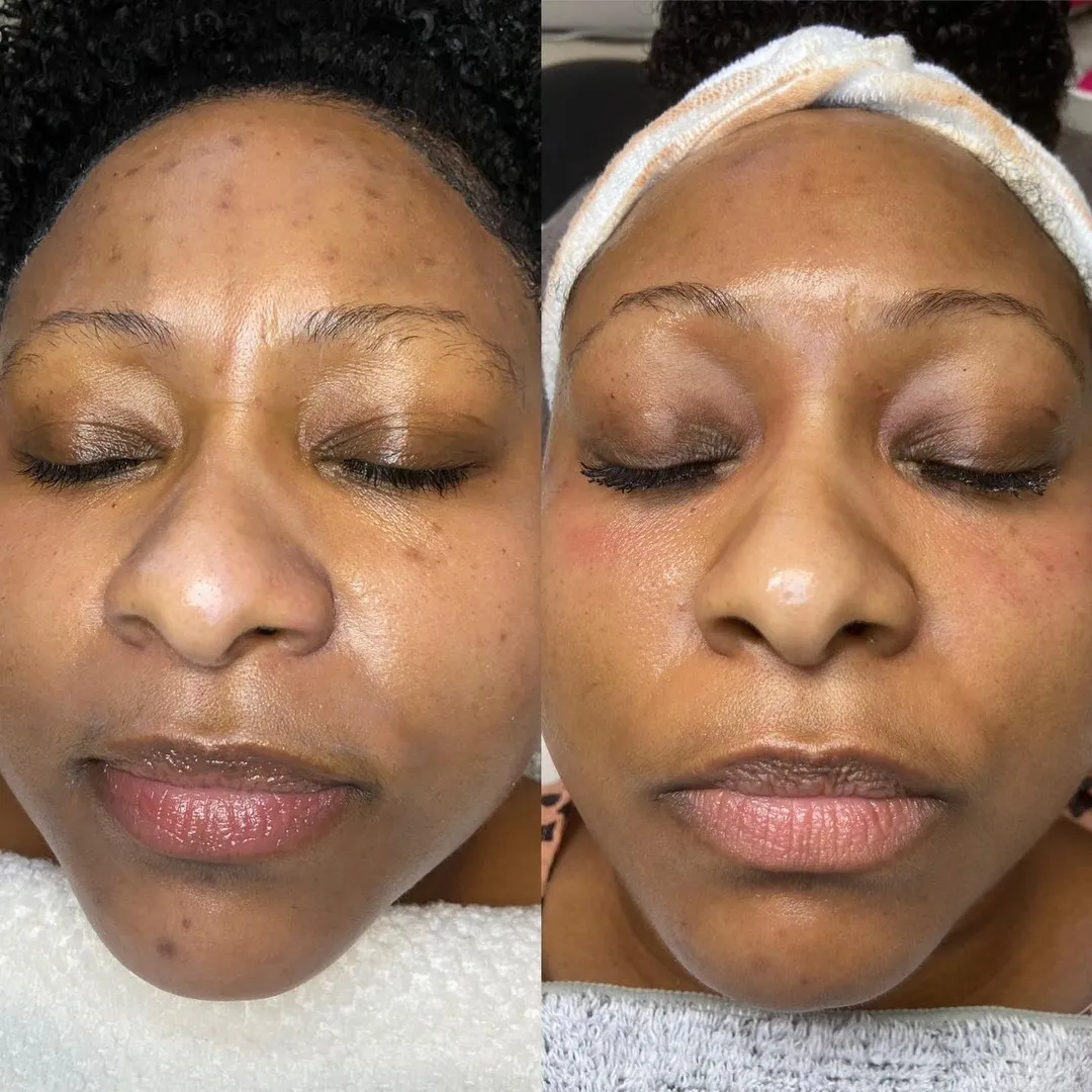 Chemical peel series, before and after