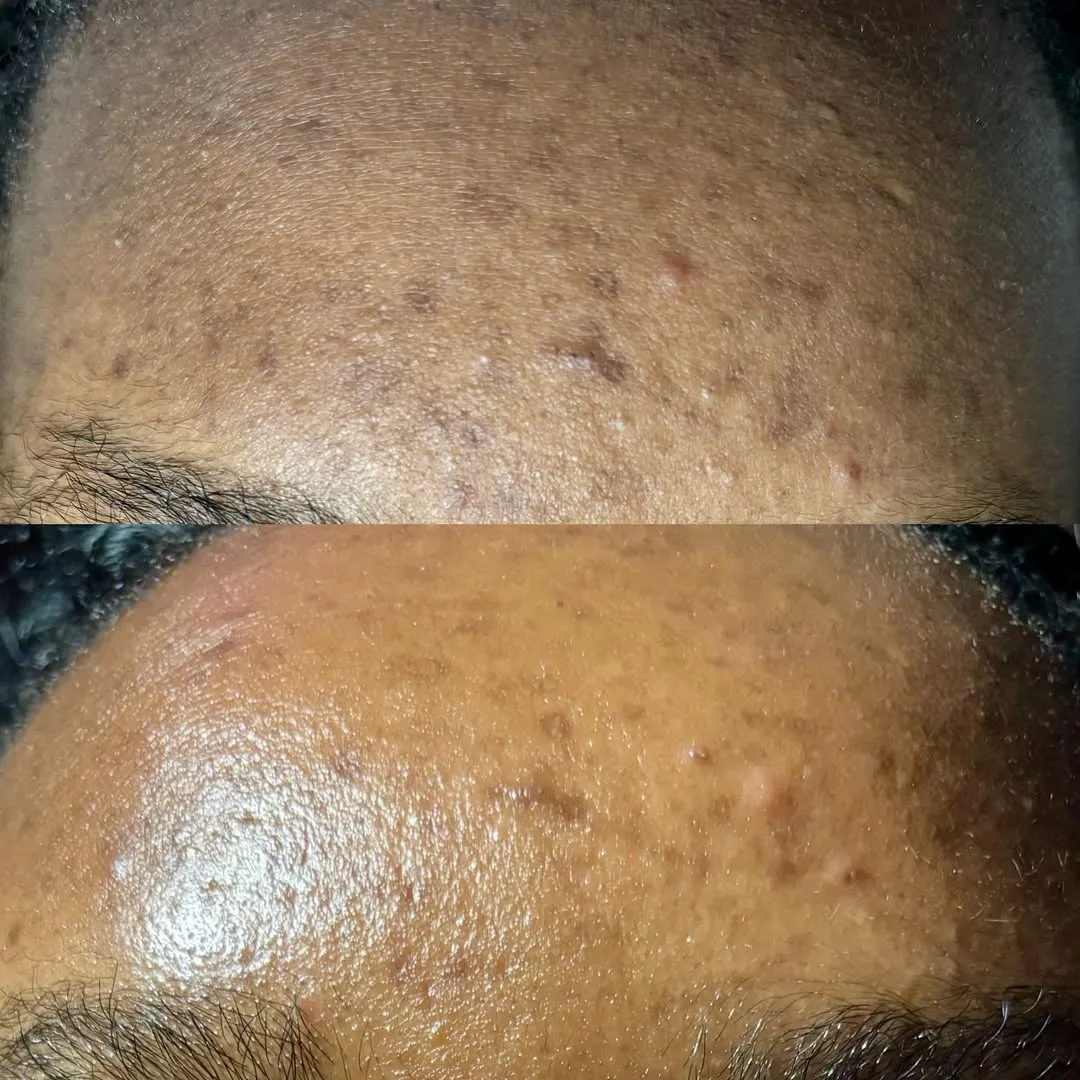 One peel, before and after