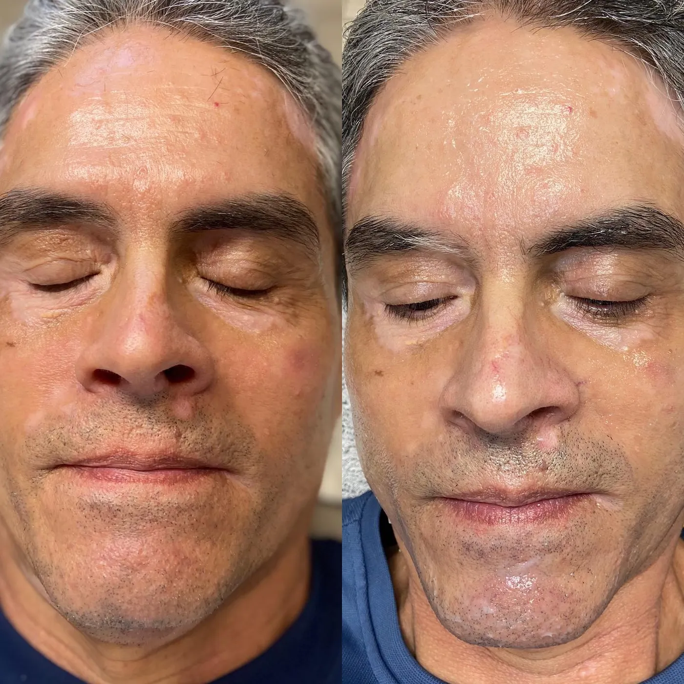 Corrective series, before and after