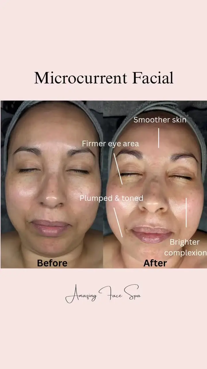 Microcurrent facial