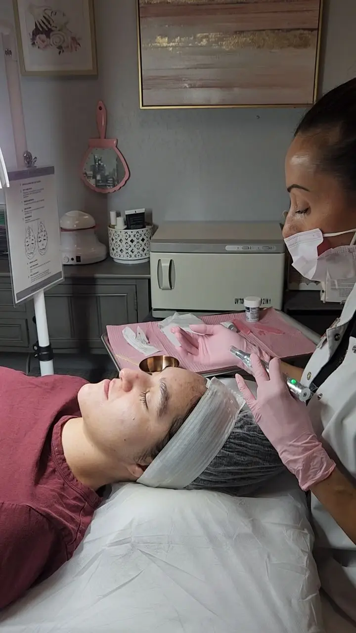 Microneedling