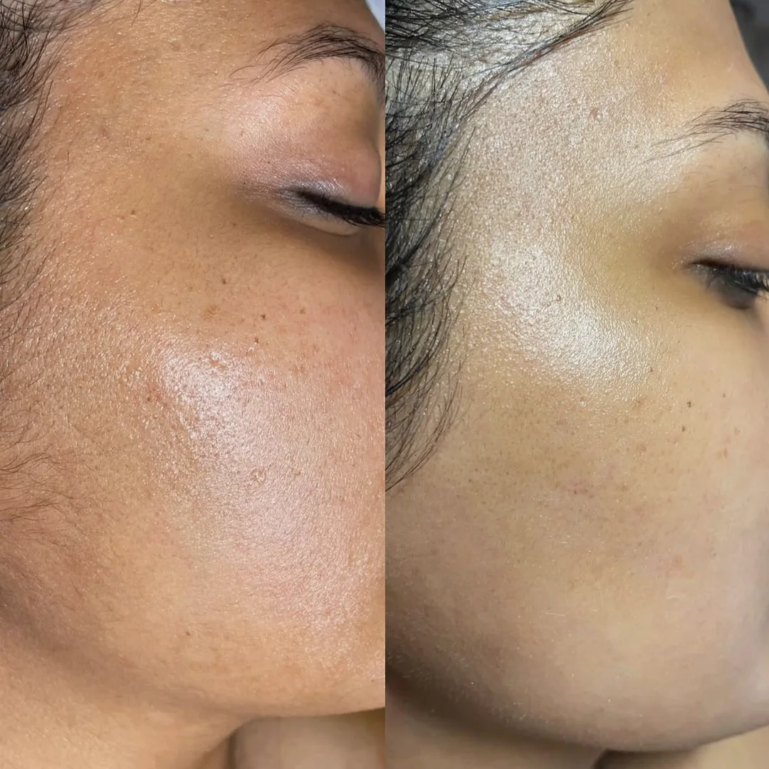Dermaplaning before and after